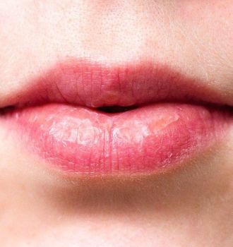 Wrinkles Above the Lips: The Best Treatments & Prevention